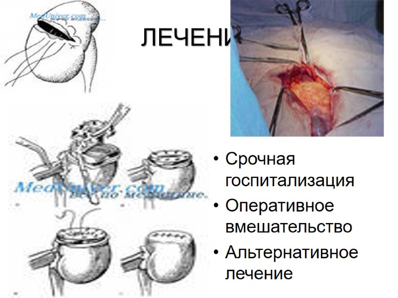 ЛЕЧЕНИЕ  Срочная госпитализация Оперативное вмешательство Альтернативное лечение